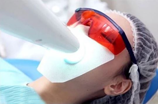 Gaze za lice prilikom beljenja zuba