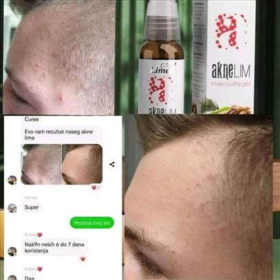 Aknelim gel protiv akni i bubuljica 